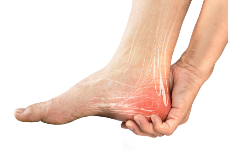 Plantar Fasciitis